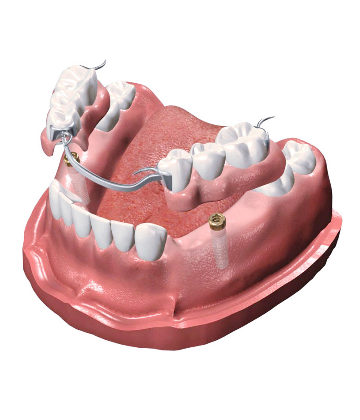 Implant Supported Removable Partial