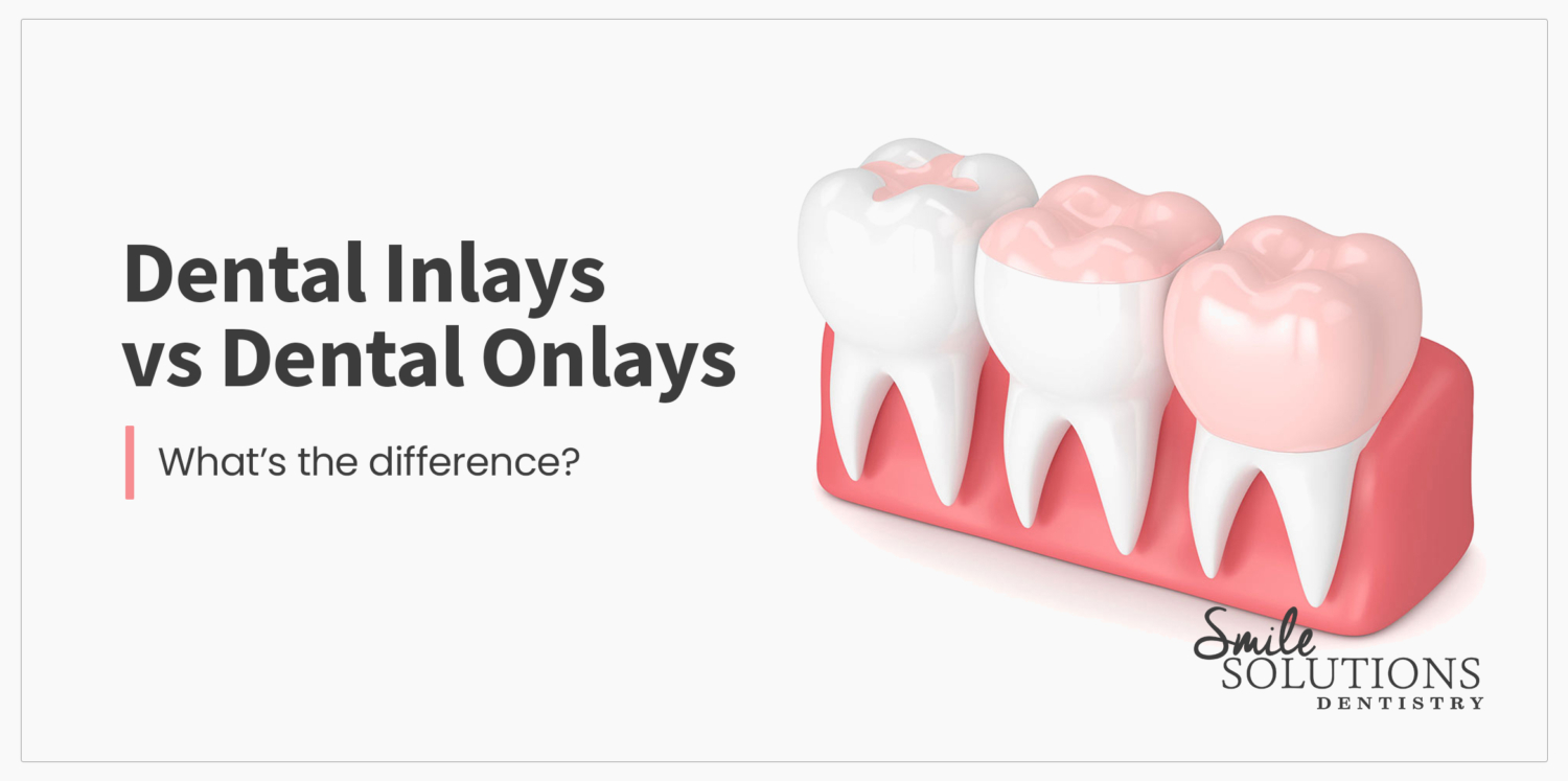 Dental Inlays Vs Onlays // Smile Solutions Family Dentistry