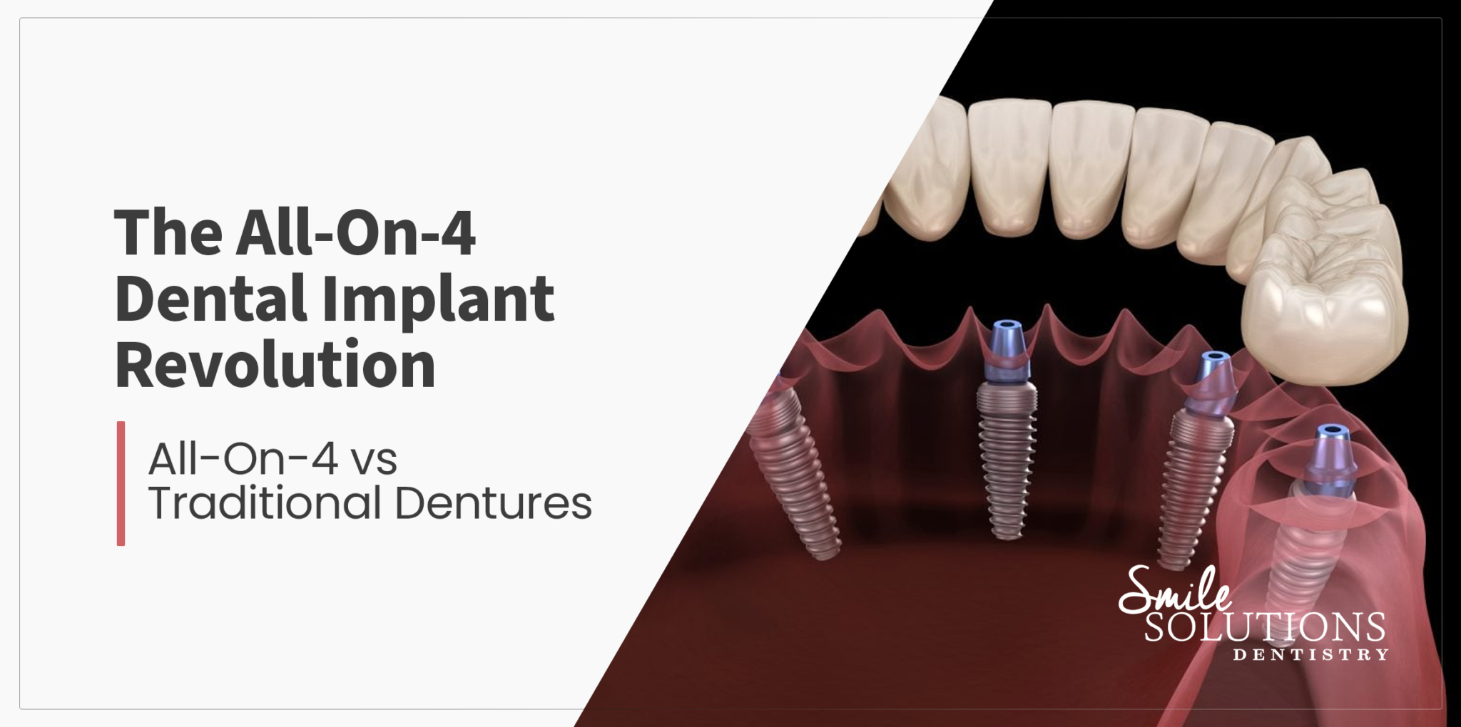 The All-On-4 Dental Implant Revolution // Smile Solutions Dentistry