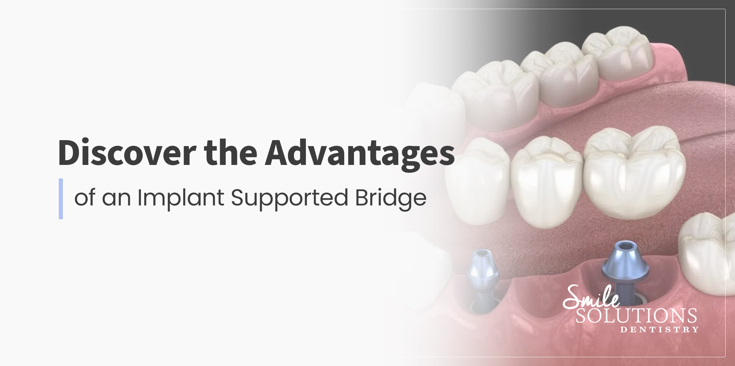 2 Implant Supported Bridge